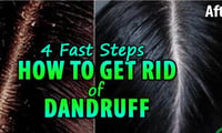 Steps to get rid of Dandruff permanently 